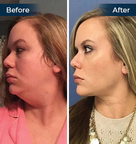 Firmio™ Sleeping V-Face Beauty Device