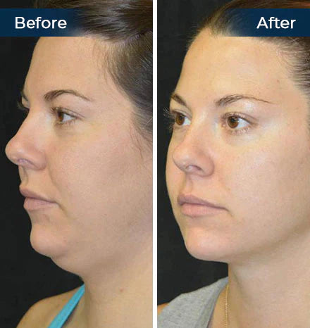 Firmio™ Sleeping V-Face Beauty Device