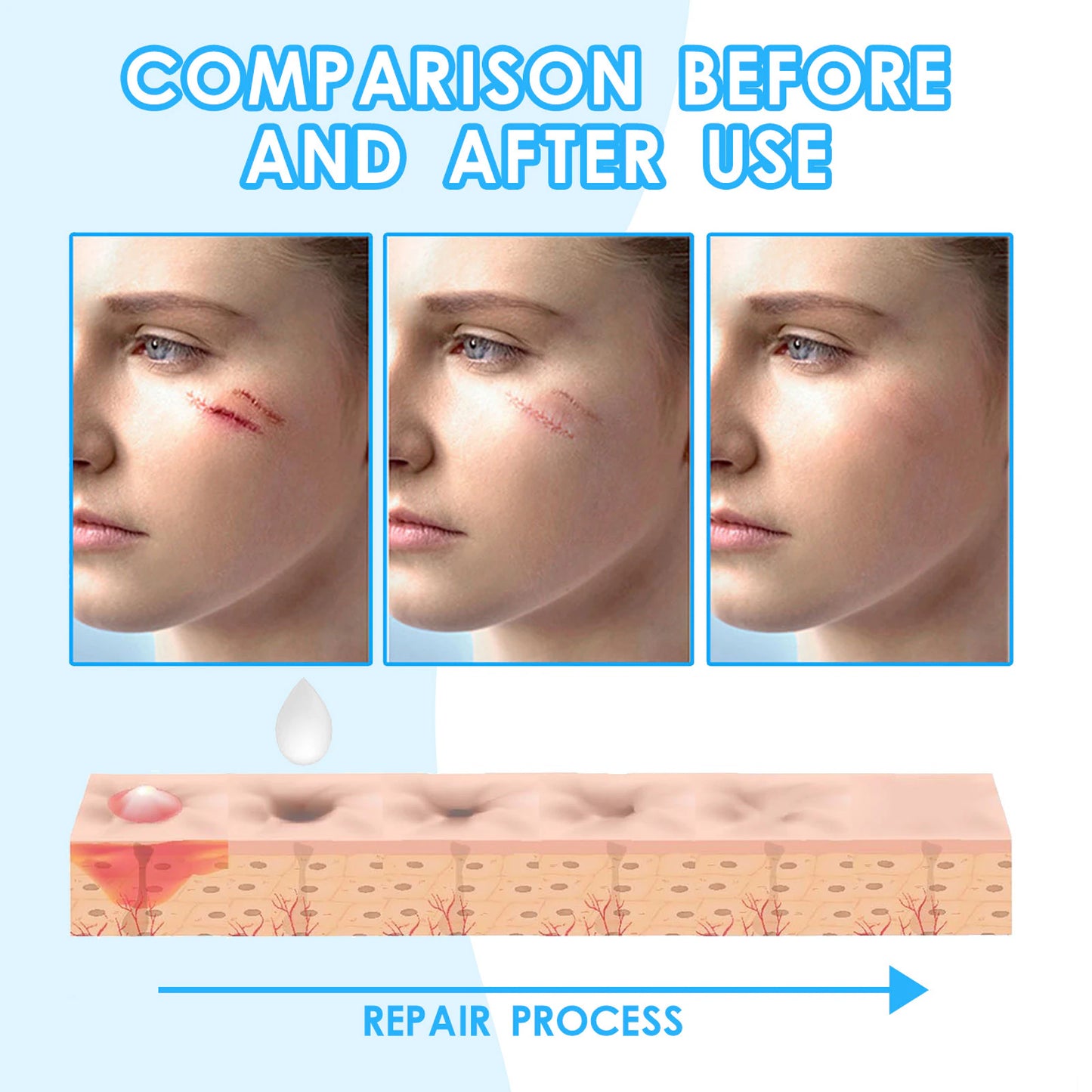 Scar cream l Special treatment for perennial scars, keloid scars, pitted scars