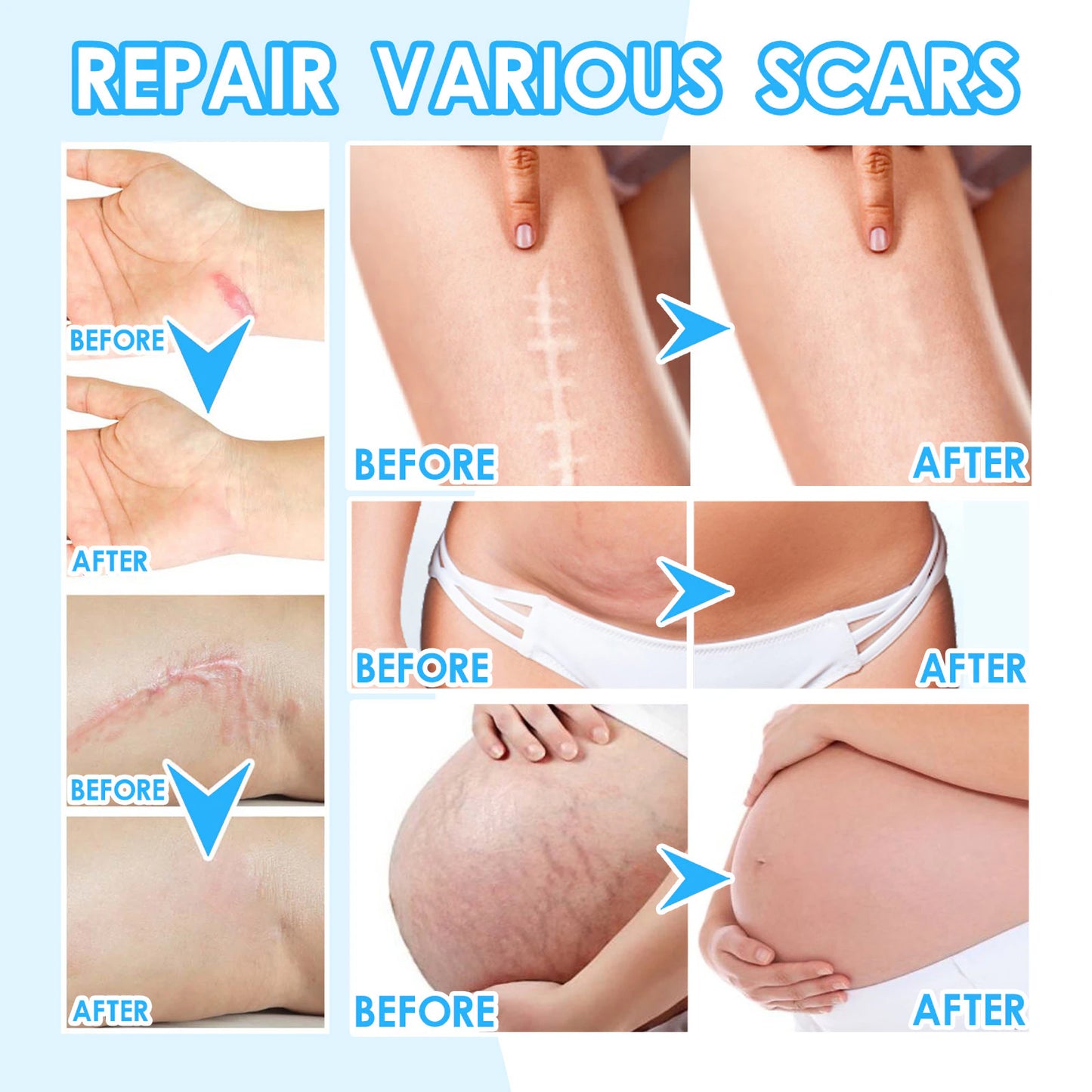 Scar cream l Special treatment for perennial scars, keloid scars, pitted scars