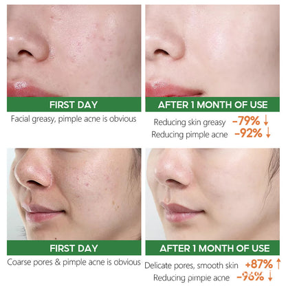 Herbal Toner VIBRANT GLAMOR for acne Blows away acne marks